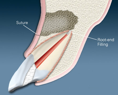 Tooth root is capped and the surgical site is sutured after completion of the procedure.