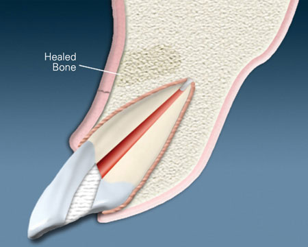 Diagram of a healed upper tooth and jaw bone after an apicoectomy