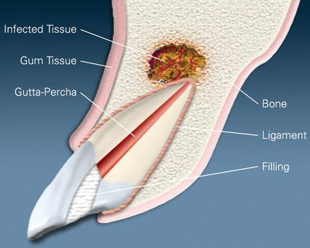 Diagram of infected tissue at the root end of a tooth in the upper jaw