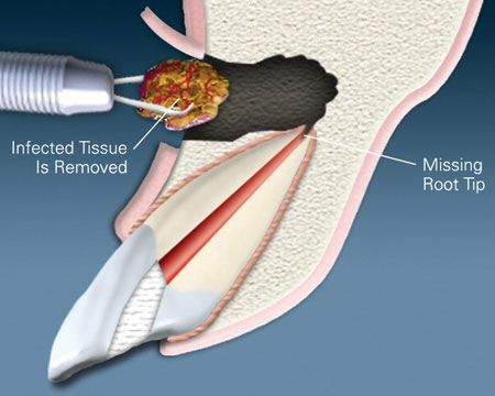 A representation of an incision made and infected tissue being removed from bone