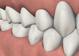 A depiction of craze lines on teeth