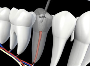 A visual of removing fillings from a tooth