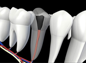 An illustration of new root filling material placed into a tooth's canals