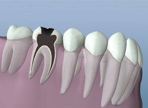 A digital illustration showing the anatomy of a tooth with cleaned canals
