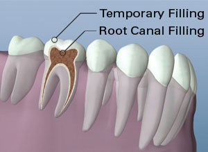 A digital illustration showing the anatomy of a tooth with a root canal filling