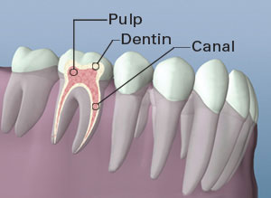 Un diagrama de anatomía dental que destaca la dentina pulpar y el canal