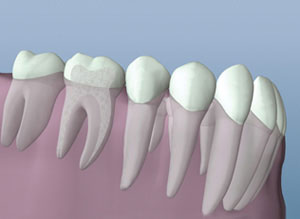 A digital illustration showing the anatomy of a healed tooth