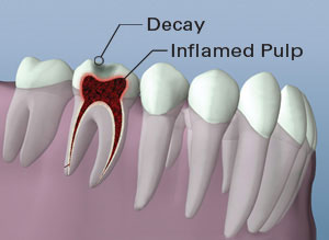 A digital illustration showing the anatomy of a tooth with inflamed pulp