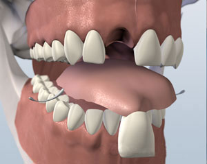 Flipper, removable plastic retainer