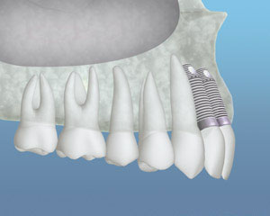 A representation of dental implants placed after bone grafting