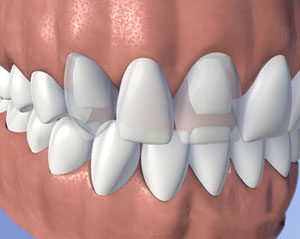 An example of a dental fixed bridge