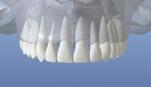A depiction of the upper jaw with all normal teeth