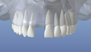 An representation of a healed upper jaw bone after loosing a tooth