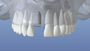 An digital representation of the initial dental implant placed in the jaw bone
