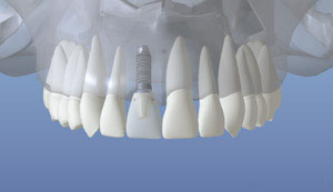 Dental Implant Restored