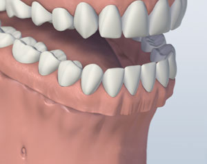 A representation of a full denture for the entire lower jaw
