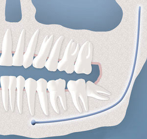 An example of a wisdom tooth with a partial bony impaction