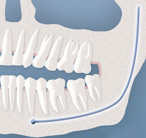 A representation of a wisdom tooth with a soft tissue impaction