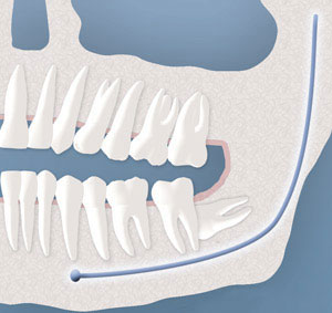 Wisdom Teeth illustration: Non-erupted lower tooth impacting normal tooth root in lower jaw