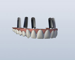 An Implant Retained Upper Denture with its implants attached