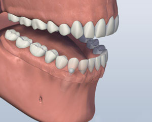 A mouth with a Ball Attachment Denture latched onto the lower jaw by two implants