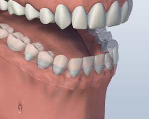 A mouth with a Bar Attachment Denture secured onto the lower jaw by four implants