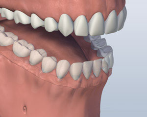 A mouth with a Screw Attachment Denture affixed onto the lower jaw by six implants