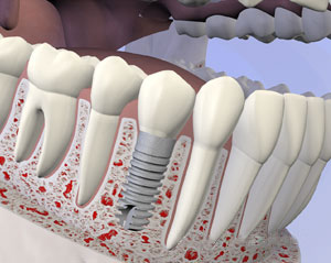 A visual of a permanent dental implant to replace missing teeth