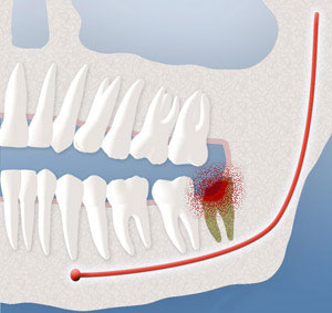 A diagram depicting an infection that occurs after wisdom teeth removal