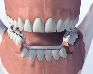 A depiction of a sturdy partial denture cast in metal and plastic