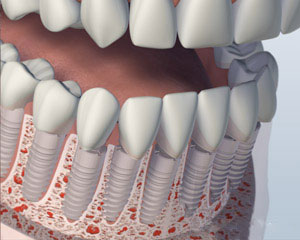 After Dental Implants Placed