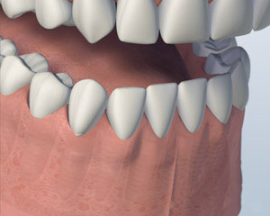 Healing completed after after dental implant