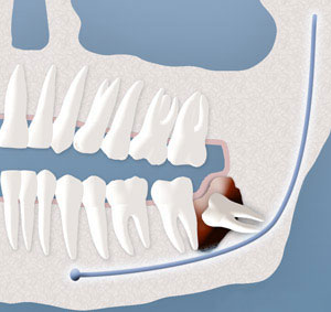 An example of a cyst formation on a wisdom tooth