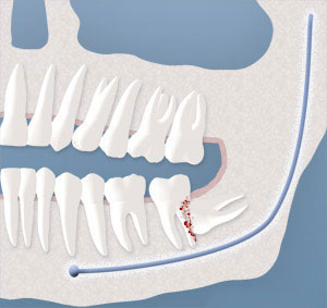 A visual of a wisdom tooth damaging an adjacent tooth