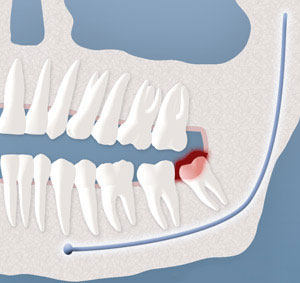 A representation of a pericoronitis infection on a wisdom tooth