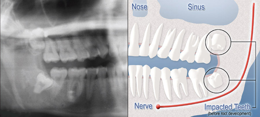 X-Ray and Diagram of Impacted Wisdom Teeth