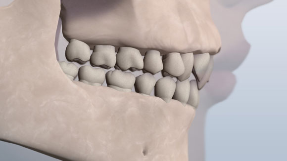 A visual of class 2 teeth with the upper front teeth overlapping the bottom teeth