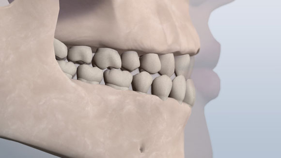 Un visual de los dientes frontales superiores que descansan detrás del menor debido a los dientes desalineados