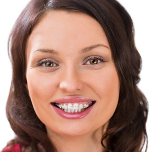 A smiling woman wearing clear ceramic braces