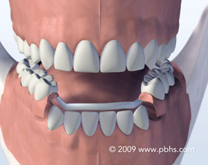 Illustration of a Metal Partial, removable partial denture