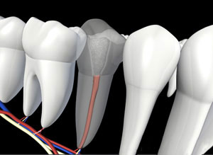 Illustration of a root canal tooth with new canal filling restored