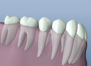 Root Canal Therapy illustrartion, Dr. Goldfein DMD