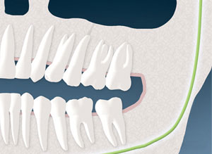 root canal surgery illustration, Dr. Goldfein Englewood NJ