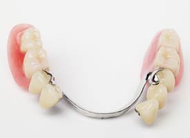 A prosthetic partial denture to replace missing upper back teeth