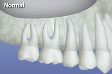 Animation showing the process of replacing a missing teeth with a dental implant