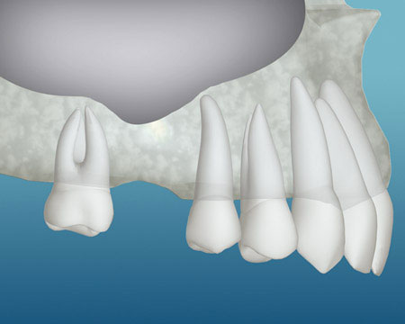 Upper jaw lacking enough bone in the back of the mouth for a dental implant; illustration