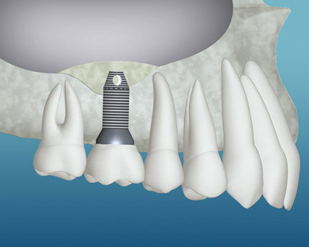 After sinus lift healing - dental implant placed and crown restored in upper jaw; illustration