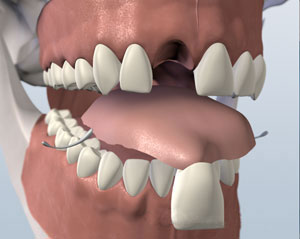 Illustration of a removable retainer with a plastic upper tooth, known as a Flipper