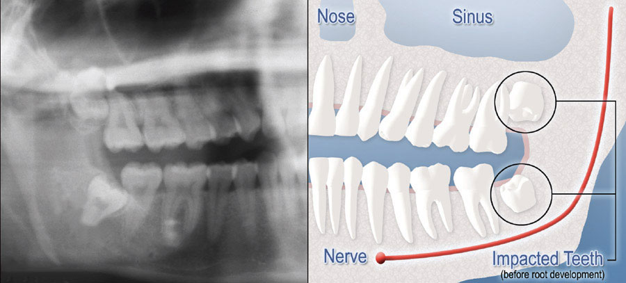 A diagram with the left half showing an x-ray of a mouth mouth with teeth impaction and the right half showing a digital graphic highlighting impacted teeth