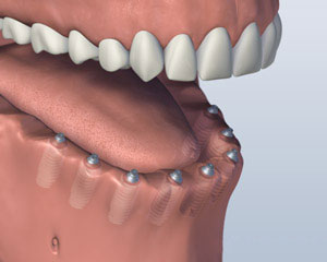 thumbnail image 2 of SKATTOOTH Dental Implant Model – Upper & Lower Jaw With 6 Implants For Overdenture Restoration Training 2 of 2